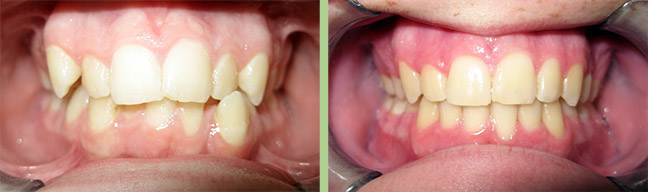 Image Orthodontics - Before and After Photos