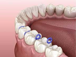 Separators create space between teeth.