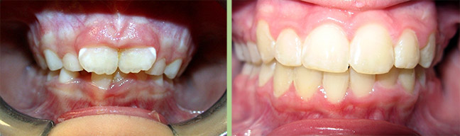 Image Orthodontics - Before and After Photos